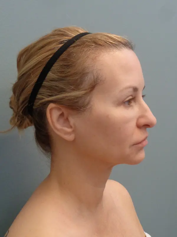 Before & After Pictures in Nashville, TN