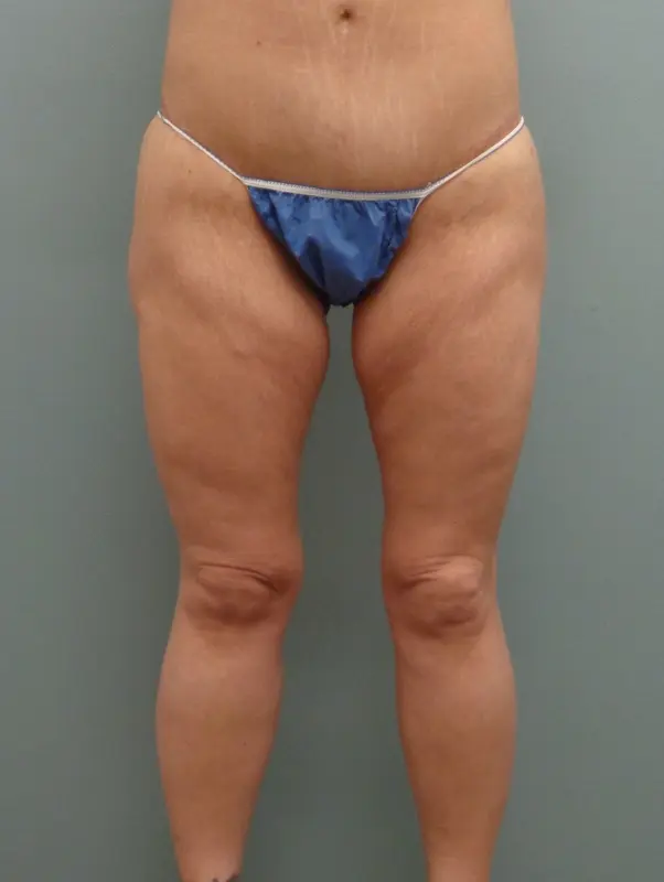 Before & After Pictures in Nashville, TN