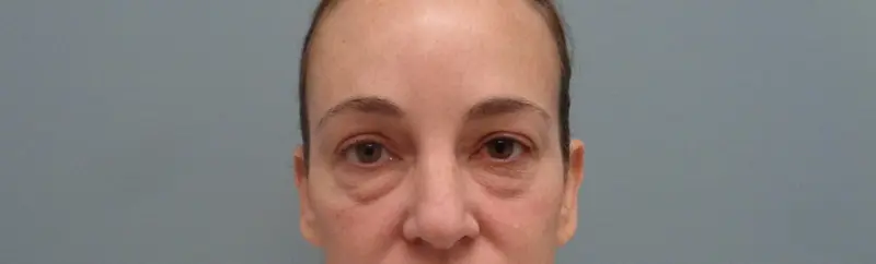 Before & After Pictures in Nashville, TN