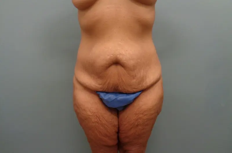Before & After Pictures in Nashville, TN