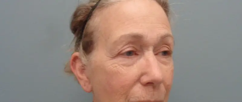 Before & After Pictures in Nashville, TN
