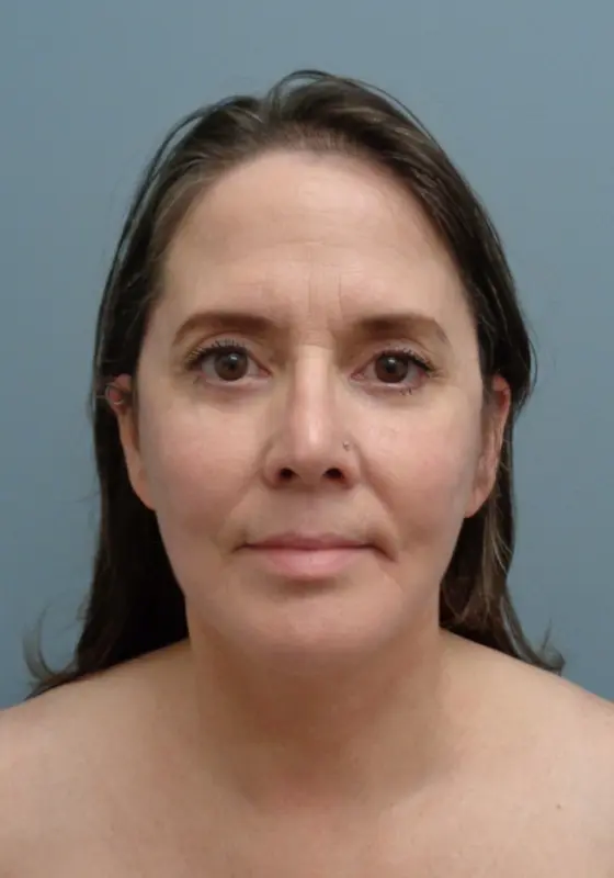 Before & After Pictures in Nashville, TN