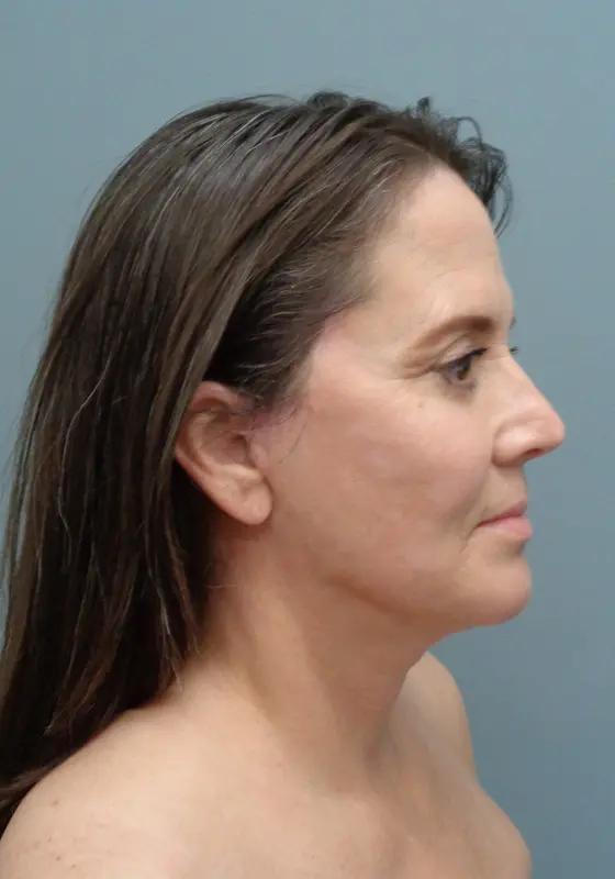 Before & After Pictures in Nashville, TN