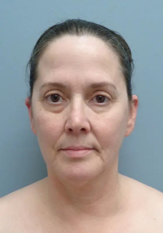 Before & After Pictures in Nashville, TN