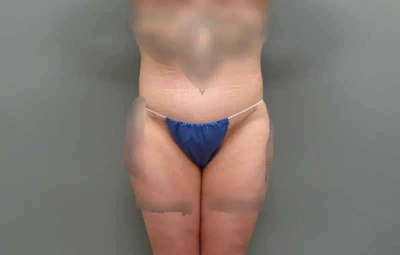 Before & After Pictures in Nashville, TN