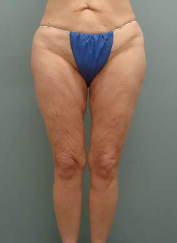 Before & After Pictures in Nashville, TN