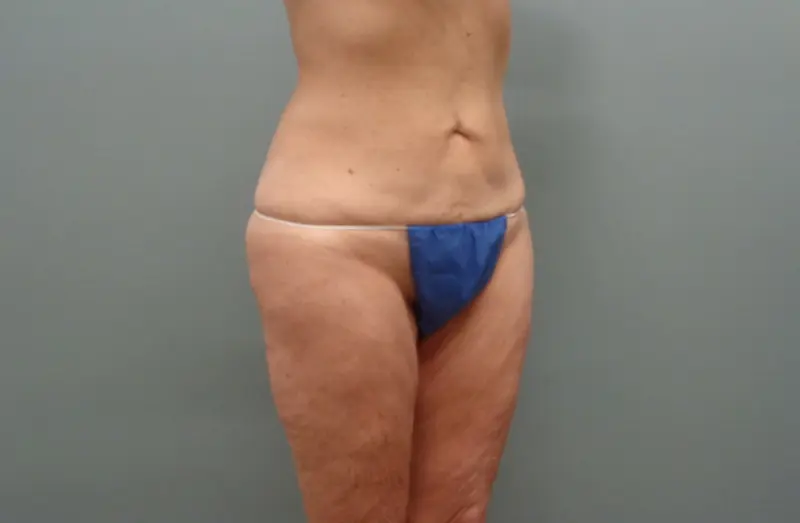 Before & After Pictures in Nashville, TN