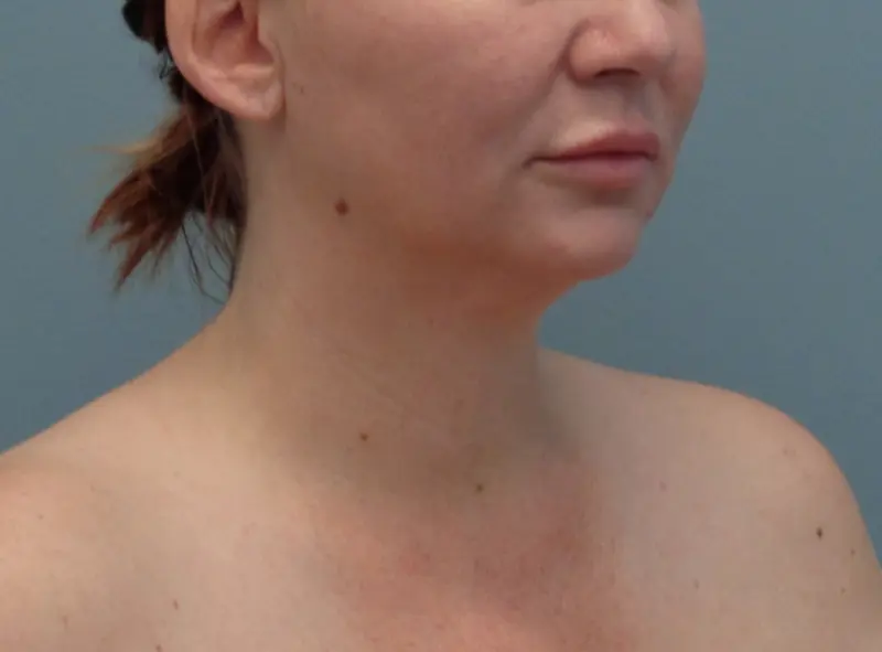 Before & After Pictures in Nashville, TN