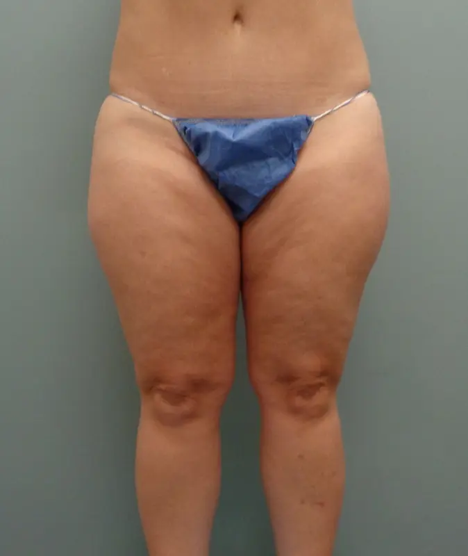 Before & After Pictures in Nashville, TN