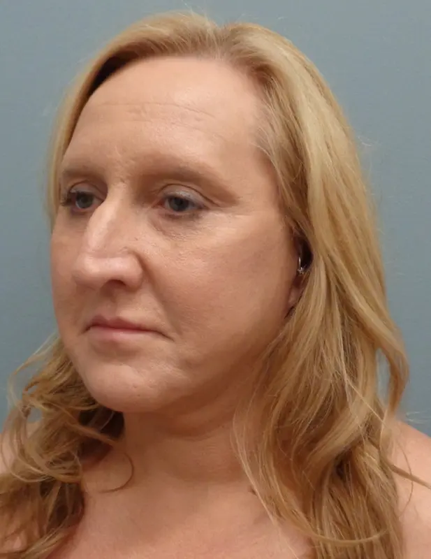 Before & After Pictures in Nashville, TN