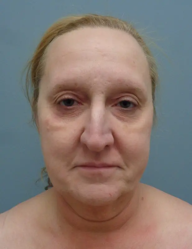 Before & After Pictures in Nashville, TN