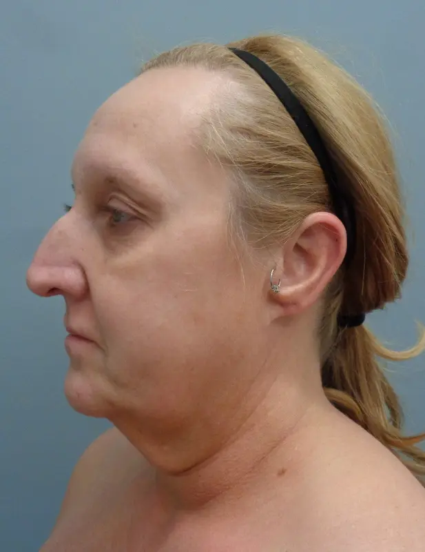 Before & After Pictures in Nashville, TN