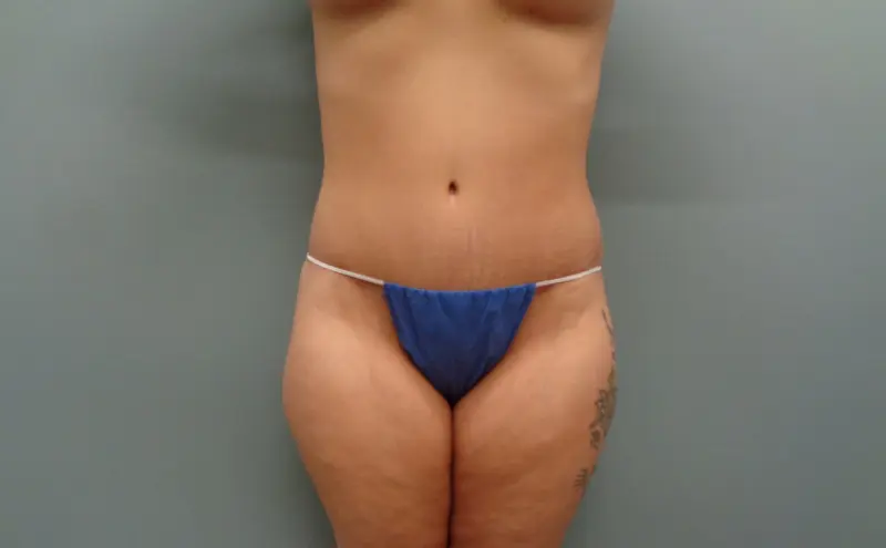 Before & After Pictures in Nashville, TN