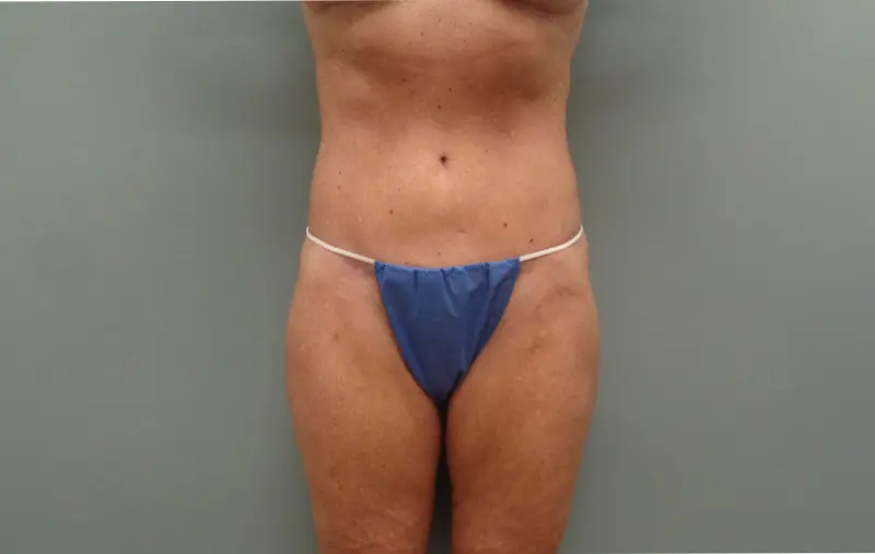 Before & After Pictures in Nashville, TN