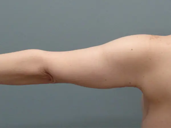 Arm Lift Before and After Pictures Nashville, TN