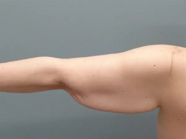 Arm Lift Before and After Pictures Nashville, TN