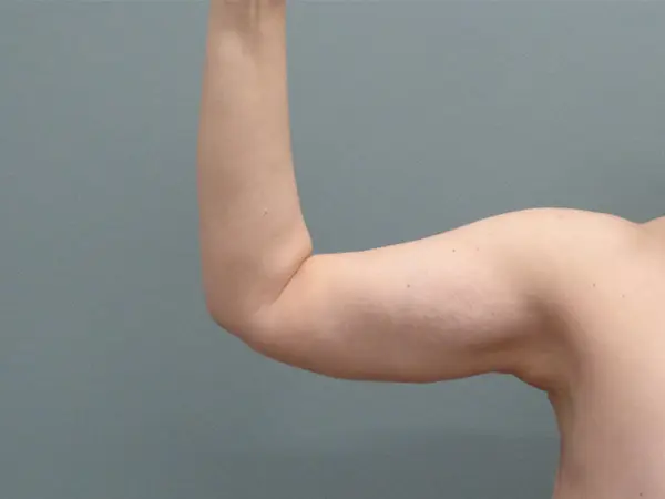 Arm Lift Before and After Pictures Nashville, TN