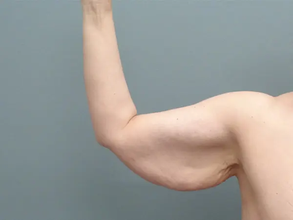 Arm Lift Before and After Pictures Nashville, TN