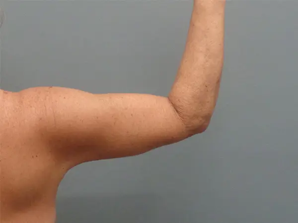 Arm Lift Before and After Pictures Nashville, TN