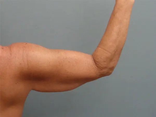 Arm Lift Before and After Pictures Nashville, TN