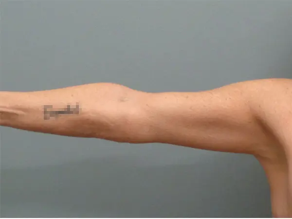Arm Lift Before and After Pictures Nashville, TN