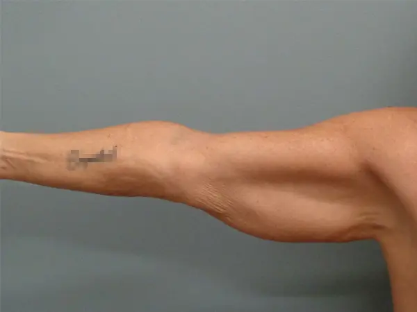 Arm Lift Before and After Pictures Nashville, TN