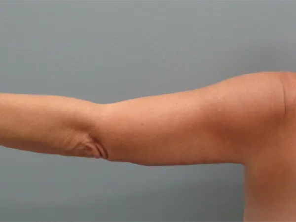 Arm Lift Before & After Pictures