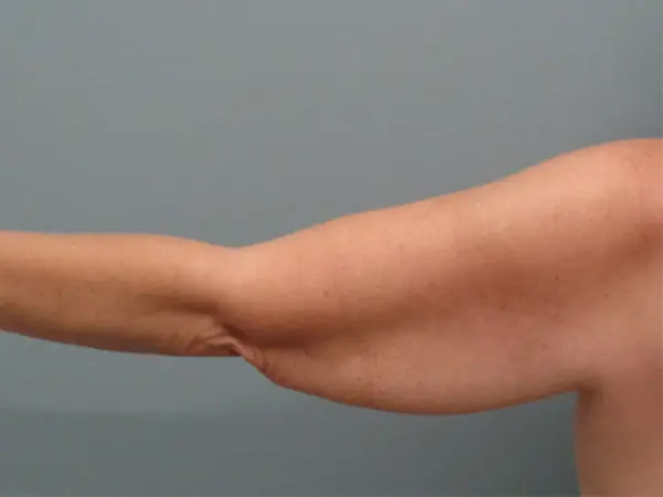 Arm Lift Before & After Pictures