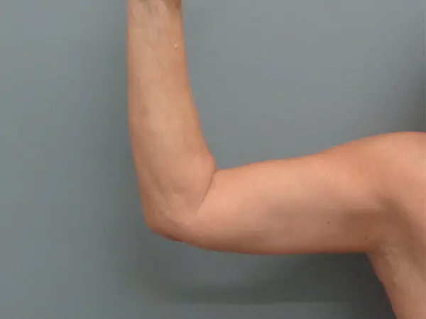 Arm Lift Before & After Pictures