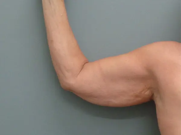 Arm Lift Before & After Pictures