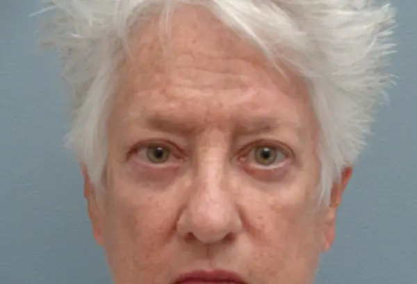Blepharoplasty Before and After Pictures Nashville, TN