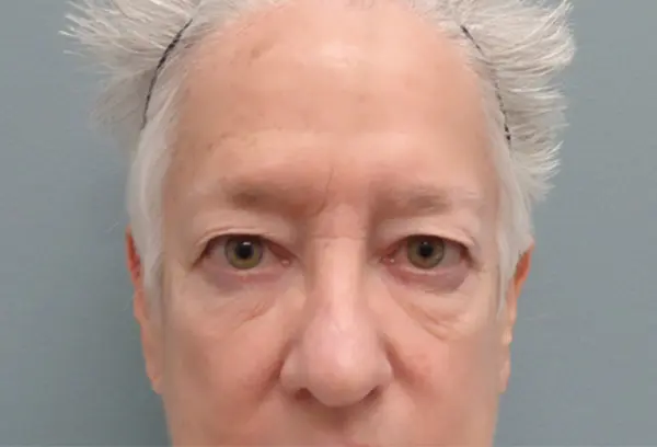 Blepharoplasty Before and After Pictures Nashville, TN