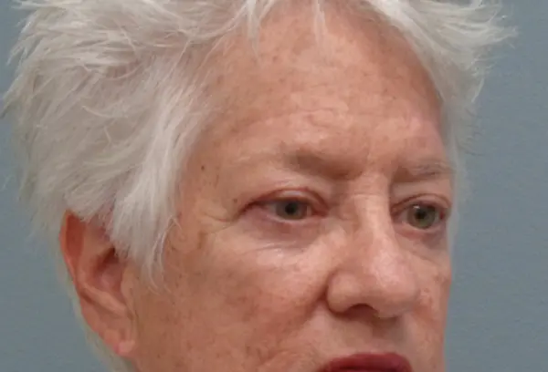 Blepharoplasty Before and After Pictures Nashville, TN