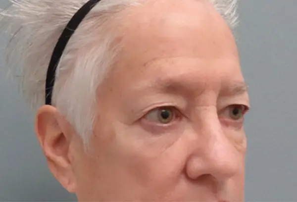 Blepharoplasty Before and After Pictures Nashville, TN