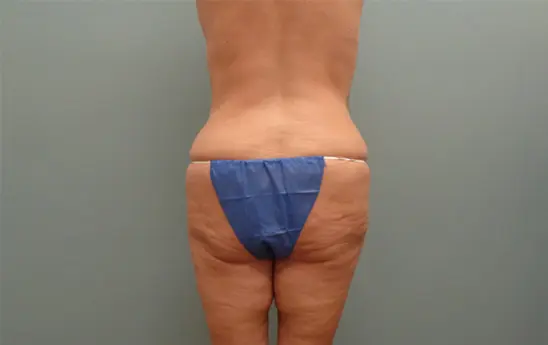 Body Lift Before & After Pictures