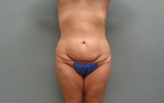 Body Lift Before & After Pictures
