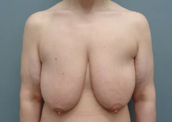 Breast Augmentation with Lift Before and After Pictures Nashville, TN