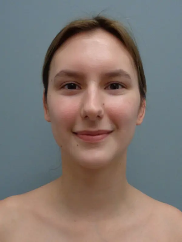Otoplasty Before and After Pictures Nashville, TN