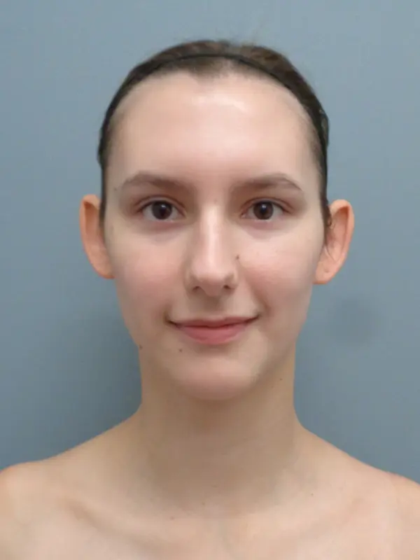 Otoplasty Before and After Pictures Nashville, TN