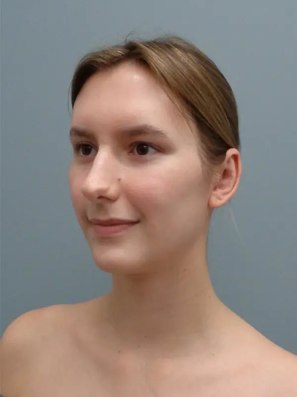 Otoplasty Before and After Pictures Nashville, TN