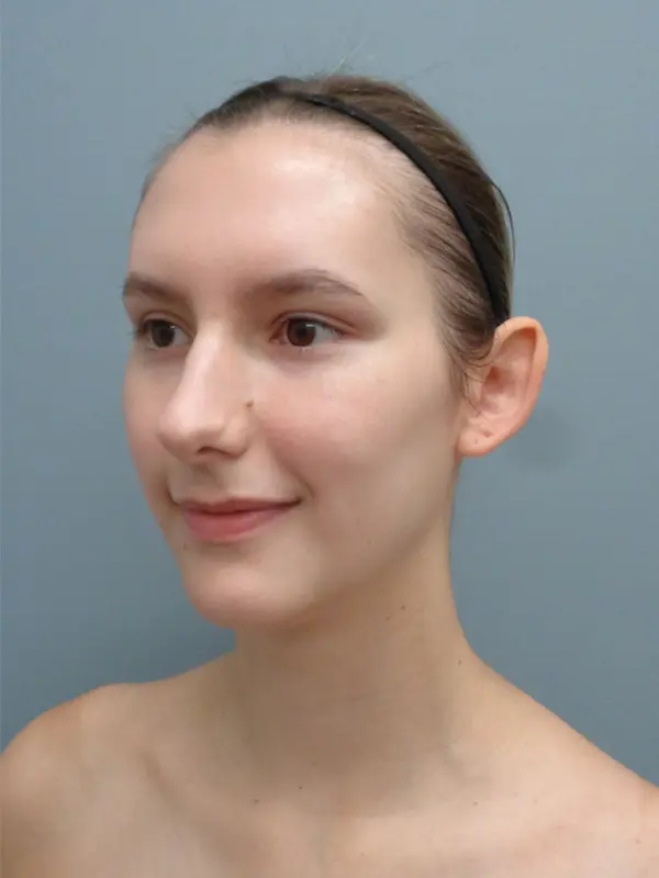 Otoplasty Before and After Pictures Nashville, TN