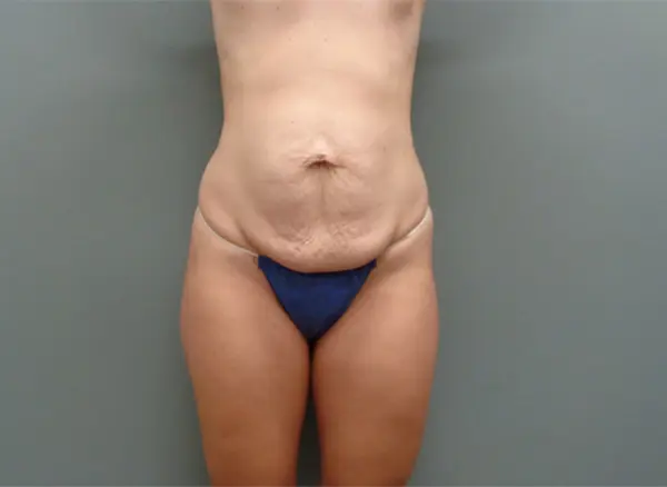 Tummy Tuck Before & After Pictures Nashville, TN
