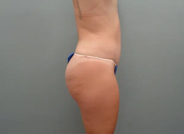 Tummy Tuck Before & After Pictures Nashville, TN