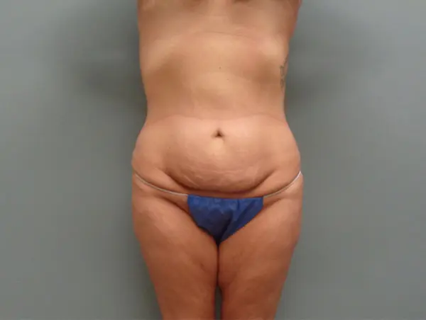 Tummy Tuck Before & After Pictures Nashville, TN