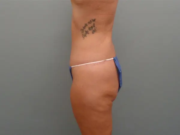Tummy Tuck Before & After Pictures Nashville, TN