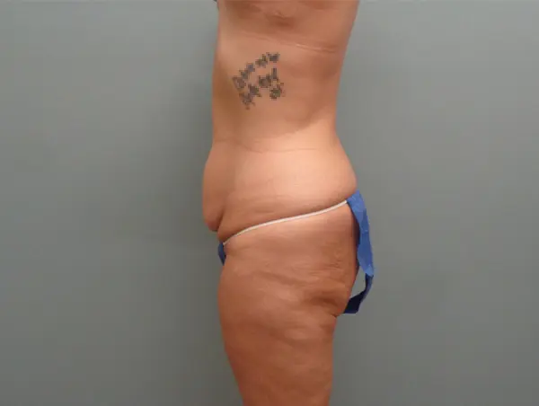 Tummy Tuck Before & After Pictures Nashville, TN