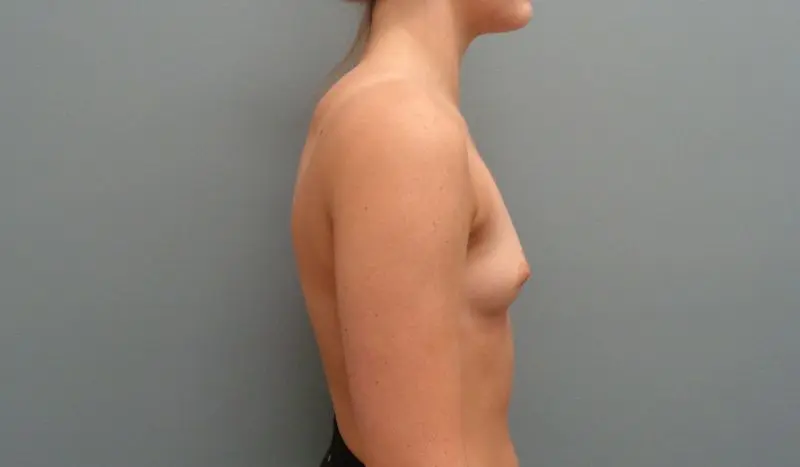 Breast Augmentation Before & After Pictures
