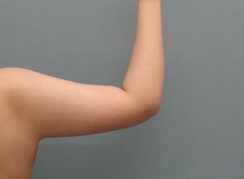 Arm Lift Before & After Pictures