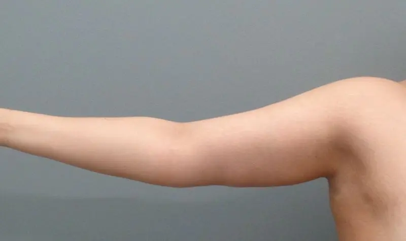 Arm Lift Before & After Pictures