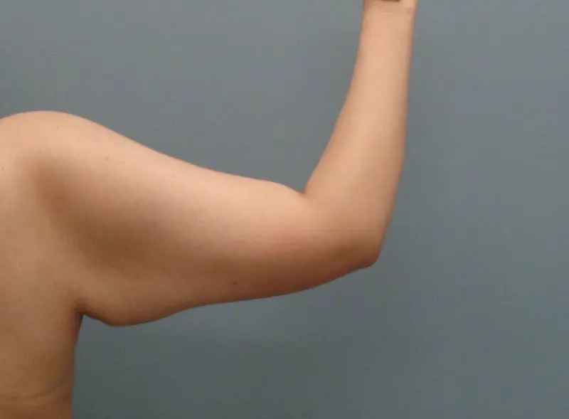 Arm Lift Before & After Pictures